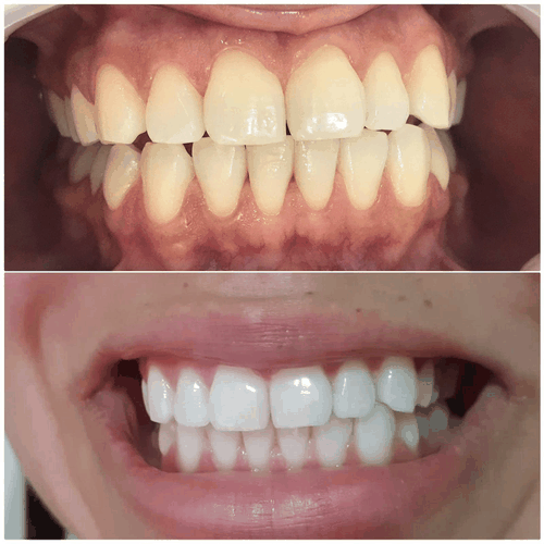 Clareamento Dental antes e depois