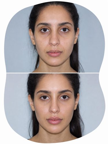 Harmonização Facial