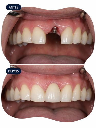 Implante Dentário - OdontoSpecial Barueri