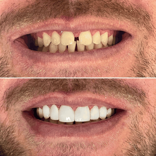 Lentes de Contato Dental